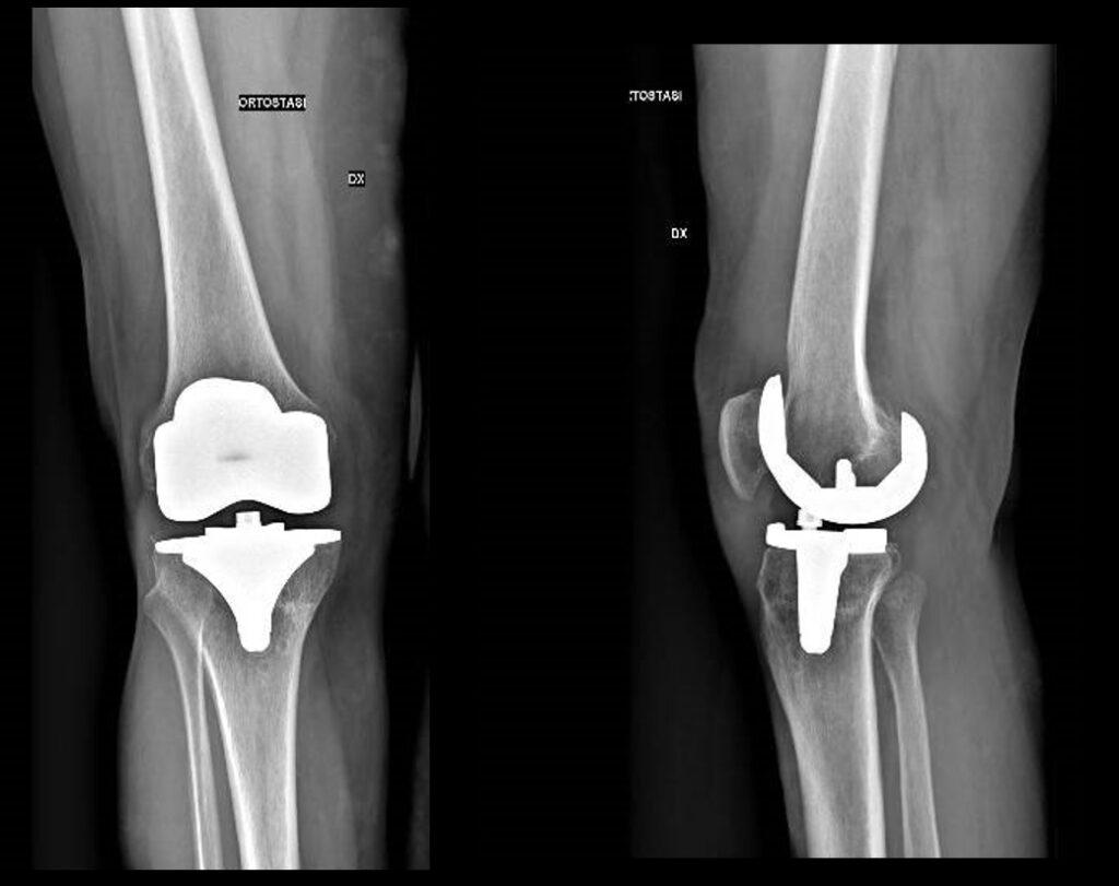 artroprotesi ginocchio radiografica protesi ginocchio a pivot mediale 