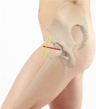 incisione artroprotesi anca
